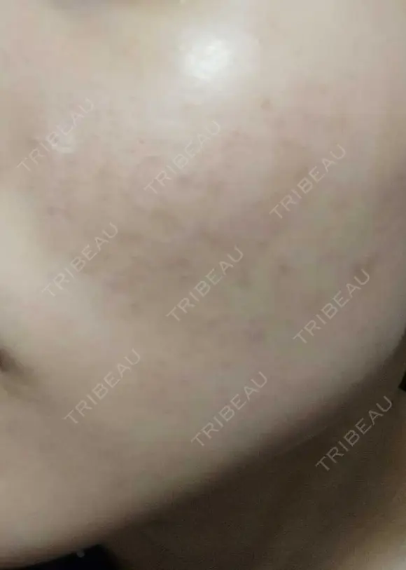 ピーリング（ニキビ・毛穴） 表参道スキンクリニック 大阪院 DAY 5 メイン用