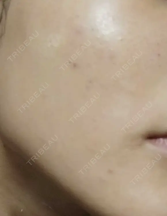 ピーリング（ニキビ・毛穴） 表参道スキンクリニック 大阪院 AFTER メイン用