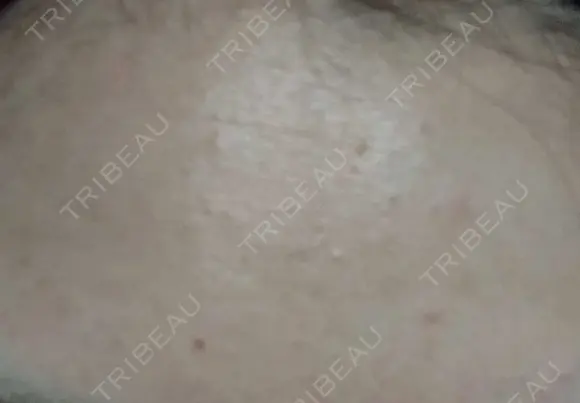 ピーリング（ニキビ・毛穴） 表参道スキンクリニック 大阪院 DAY 5 メイン用