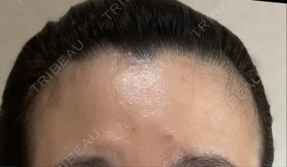 ボトックス（額） BRIGHTS beauty clinic AFTER メイン用