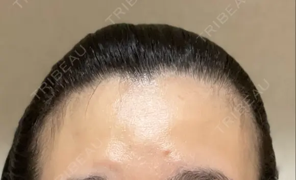 ボトックス（額） BRIGHTS beauty clinic DAY 31 メイン用