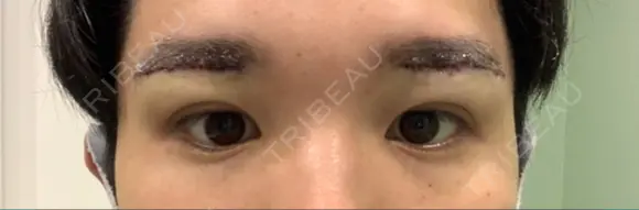 眉下切開 くさのたろうクリニック DAY 0 メイン用
