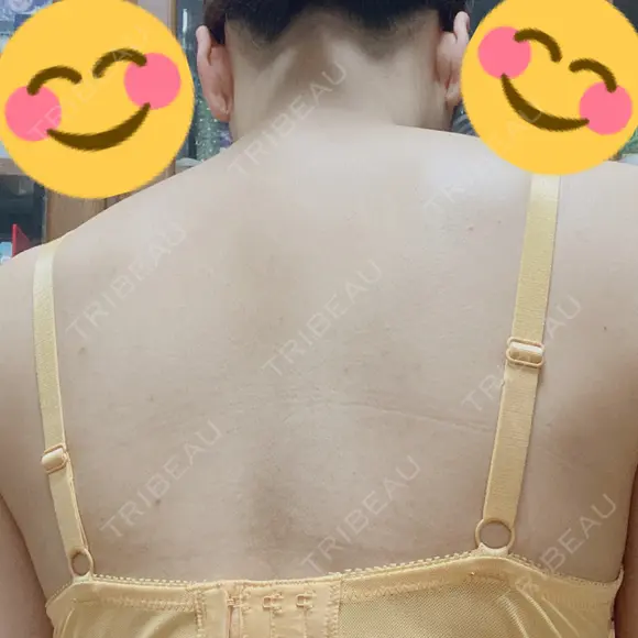 医療脱毛（背中） 渋谷美容外科クリニック 渋谷院 DAY 1 メイン用