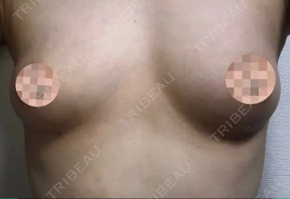 脂肪吸引（お腹） / 脂肪吸引（お尻） / 豊胸（脂肪注入） / その他（ボディ） ドクターフィット（Dr.fit）クリニック DAY 60 メイン用