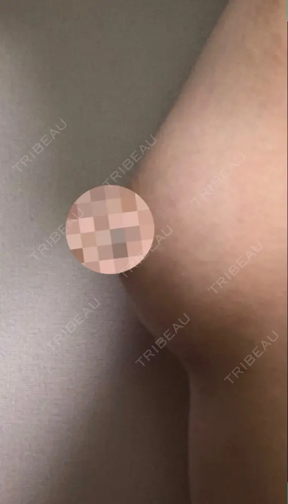 脂肪吸引（お腹） / 脂肪吸引（お尻） / 豊胸（脂肪注入） / その他（ボディ） ドクターフィット（Dr.fit）クリニック DAY 60 メイン用