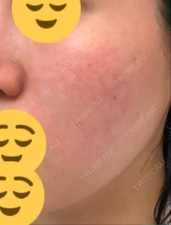 ほくろ・いぼ切除（肌） / その他（肌） / 美肌レーザー / シミ取りレーザー / 美白レーザー クロスクリニック銀座 DAY 91 メイン用