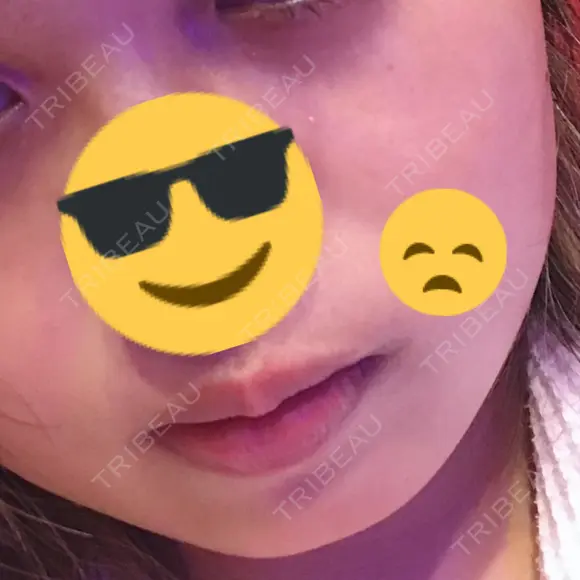 ボトックス（エラ・小顔） STARS CLINIC DAY 6 メイン用