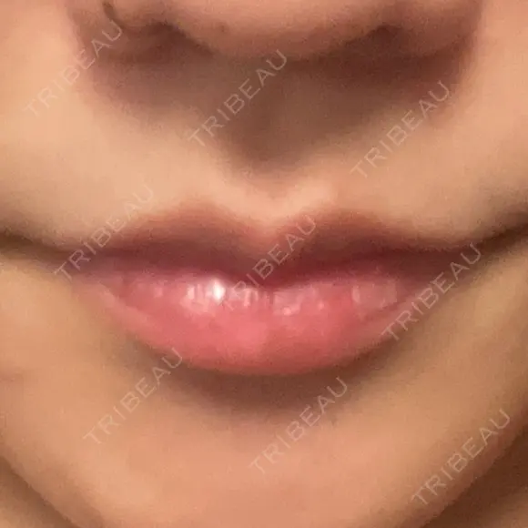 ヒアルロン酸注入（唇） / ボトックス（口角） グランメドクリニック茨木 AFTER メイン用