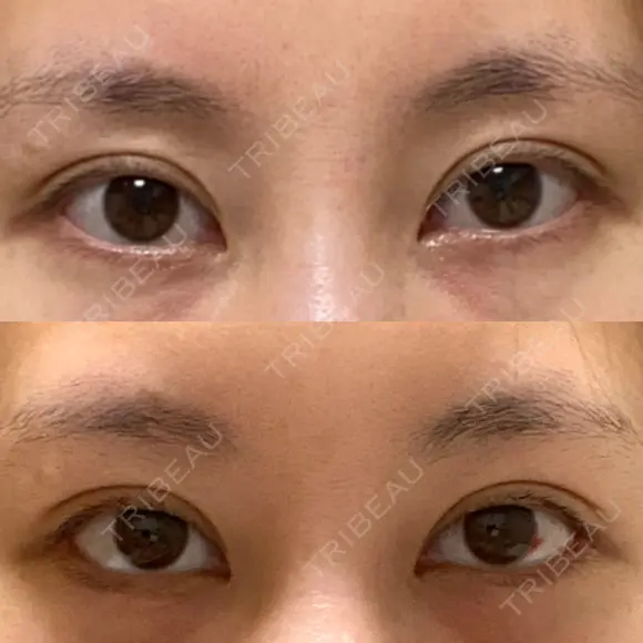 目尻切開 / タレ目形成・グラマラスライン（切開） eクリニック 金沢本院 DAY 25 メイン用