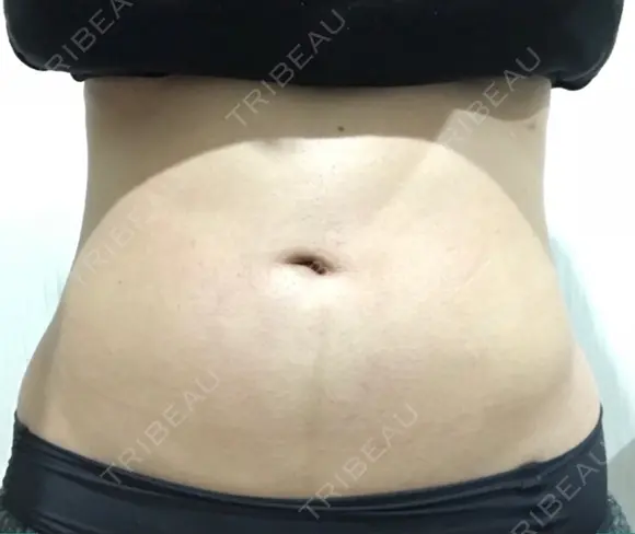 脂肪吸引（お腹） ドクターフィット（Dr.fit）クリニック AFTER メイン用