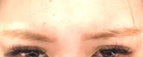 ボトックス（エラ・小顔） / ボトックス（眉間） TCB東京中央美容外科 神戸院 DAY 2 メイン用