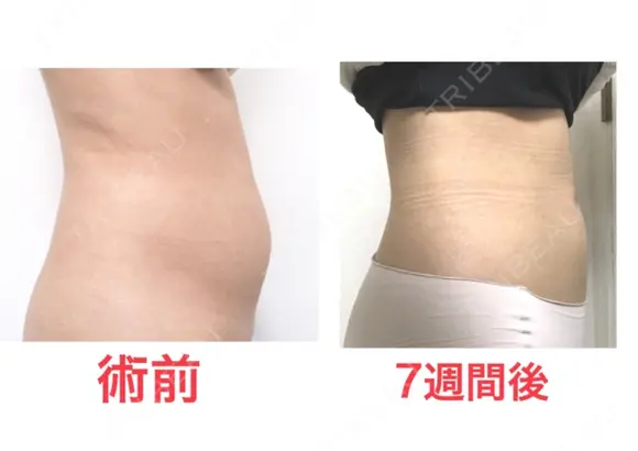 脂肪吸引（お腹） ドクターフィット（Dr.fit）クリニック DAY 51 メイン用