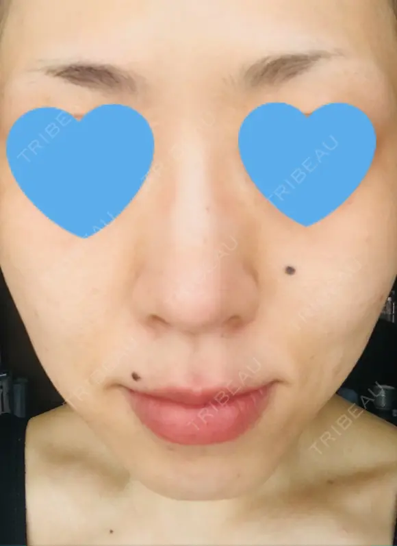 その他（肌） / ピーリング（ニキビ・毛穴） / イオン導入 / フォトシルクプラス / 光治療（フォトフェイシャルなど） / ウーバーピール / ニキビ治療 ハニークリニック DAY 13 メイン用