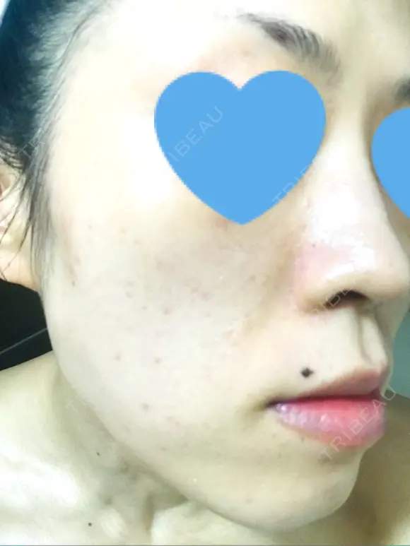 その他（肌） / ピーリング（ニキビ・毛穴） / イオン導入 / フォトシルクプラス / 光治療（フォトフェイシャルなど） / ウーバーピール / ニキビ治療 ハニークリニック DAY 10 メイン用