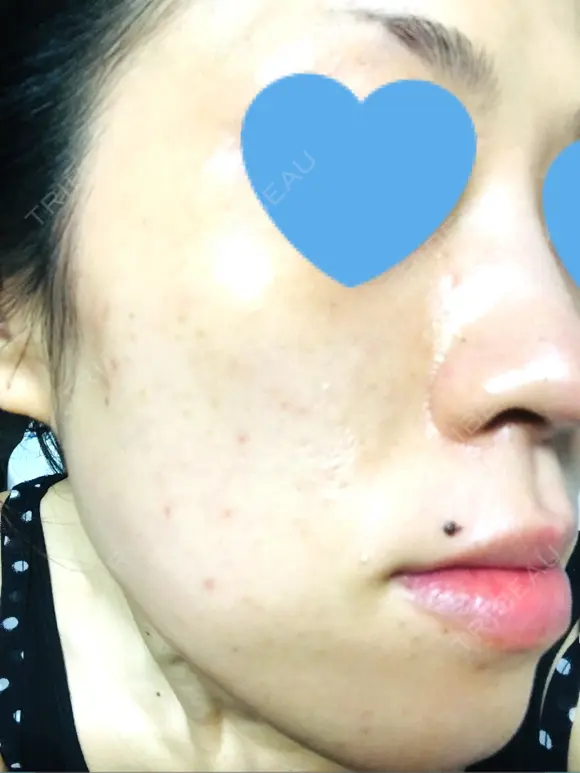 その他（肌） / ピーリング（ニキビ・毛穴） / イオン導入 / フォトシルクプラス / 光治療（フォトフェイシャルなど） / ウーバーピール / ニキビ治療 ハニークリニック DAY 9 メイン用