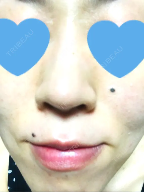 その他（肌） / ピーリング（ニキビ・毛穴） / イオン導入 / フォトシルクプラス / 光治療（フォトフェイシャルなど） / ウーバーピール / ニキビ治療 ハニークリニック DAY 9 メイン用