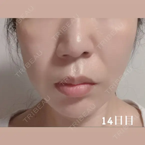 糸リフト / 脂肪吸引（顔） / ジョールファット除去 湘南美容クリニック 秋葉原院 DAY 5 メイン用