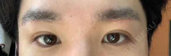 眉下切開 くさのたろうクリニック AFTER メイン用