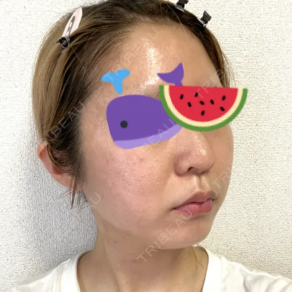 ピーリング（ニキビ・毛穴） / イオン導入 渋谷美容外科クリニック 新宿院 DAY 15 メイン用