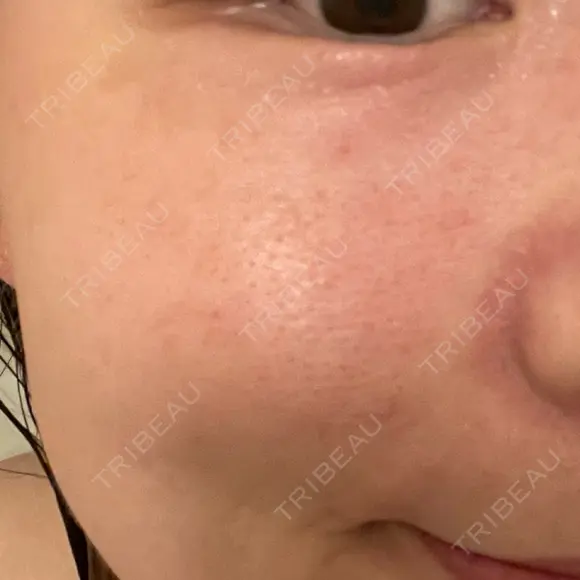 毛穴洗浄（ハイドラフェイシャルなど） 東京素肌クリニック 銀座本院 DAY 13 メイン用