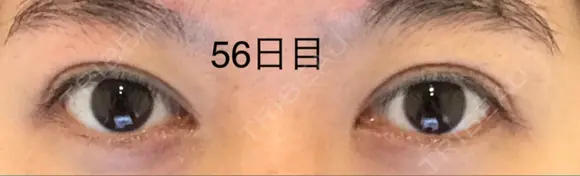 二重切開 / 上まぶたの脂肪取り 表参道スキンクリニック 表参道院 DAY 56 メイン用
