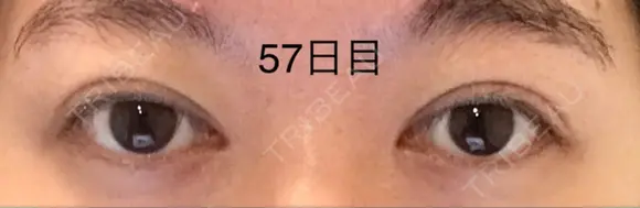 二重切開 / 上まぶたの脂肪取り 表参道スキンクリニック 表参道院 DAY 57 メイン用