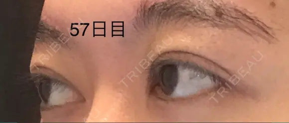 二重切開 / 上まぶたの脂肪取り 表参道スキンクリニック 表参道院 DAY 57 メイン用