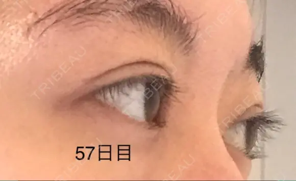 二重切開 / 上まぶたの脂肪取り 表参道スキンクリニック 表参道院 DAY 57 メイン用
