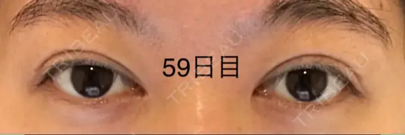 二重切開 / 上まぶたの脂肪取り 表参道スキンクリニック 表参道院 DAY 59 メイン用