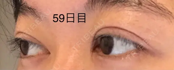 二重切開 / 上まぶたの脂肪取り 表参道スキンクリニック 表参道院 DAY 59 メイン用