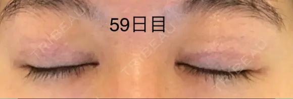 二重切開 / 上まぶたの脂肪取り 表参道スキンクリニック 表参道院 DAY 59 メイン用