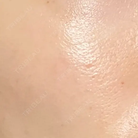 毛穴洗浄（ハイドラフェイシャルなど） 東京素肌クリニック 銀座本院 DAY 6 メイン用