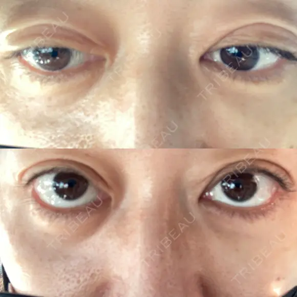 二重埋没 EMMO FACE CLINIC 大宮院 DAY 1 メイン用