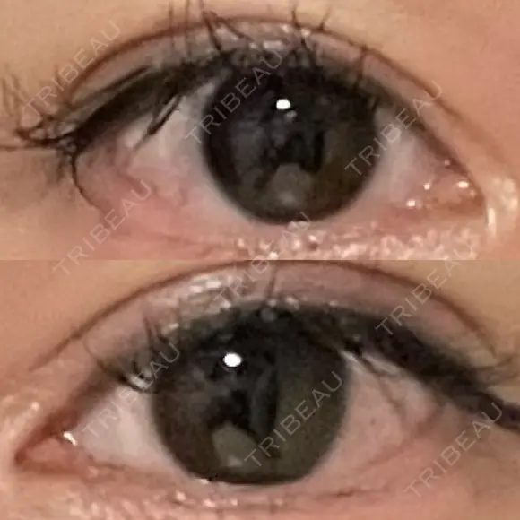 ボトックス（タレ目） STARS CLINIC AFTER メイン用