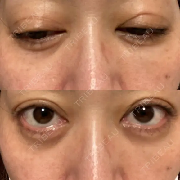 二重埋没 EMMO FACE CLINIC 大宮院 DAY 2 メイン用