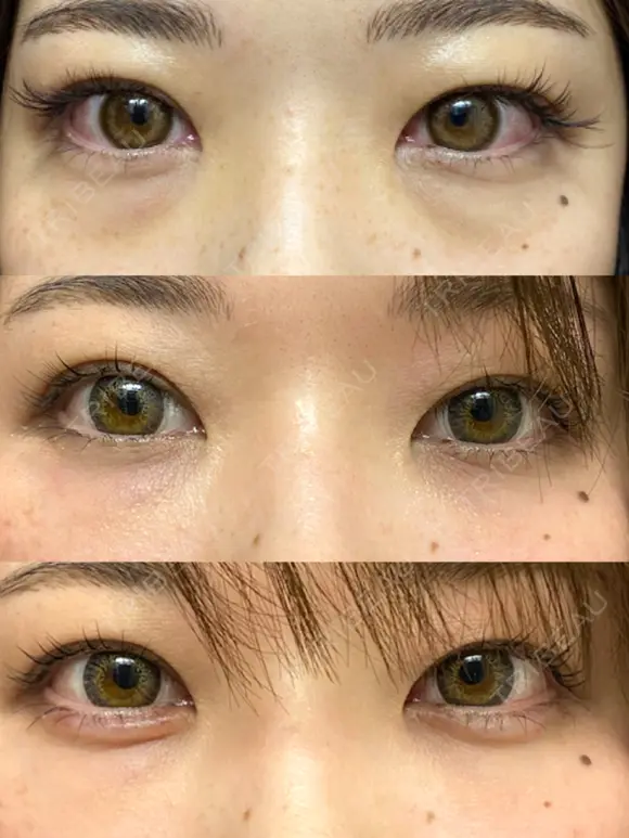 クマ治療 / 下まぶたの脂肪取り / 脂肪注入（肌） X CLINIC 大阪院 AFTER メイン用