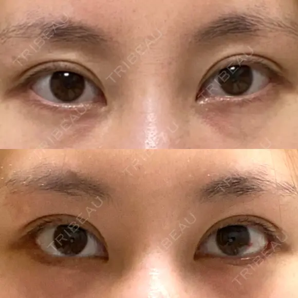 目尻切開 / タレ目形成・グラマラスライン（切開） eクリニック 金沢本院 DAY 30 メイン用