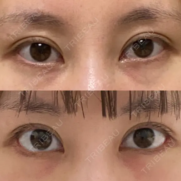 目尻切開 / タレ目形成・グラマラスライン（切開） eクリニック 金沢本院 AFTER メイン用