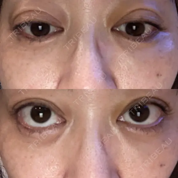 二重埋没 EMMO FACE CLINIC 大宮院 DAY 3 メイン用