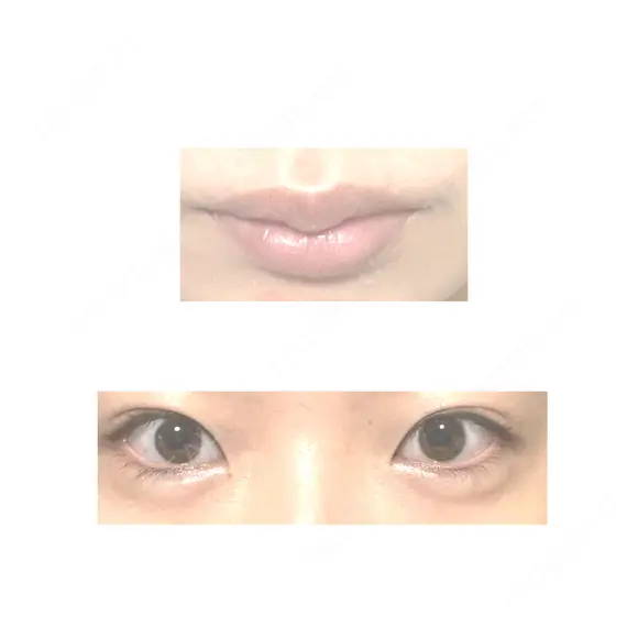 ヒアルロン酸注入（涙袋） / ヒアルロン酸注入（唇） 銀座美容外科クリニック 新宿院 AFTER メイン用