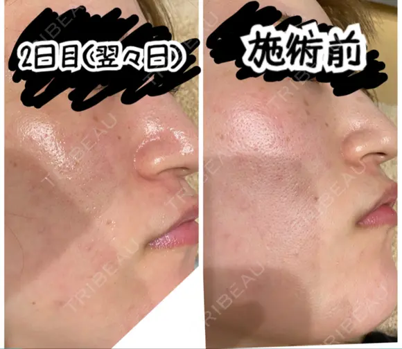 ポテンツァ レナータクリニック 立川院 AFTER メイン用