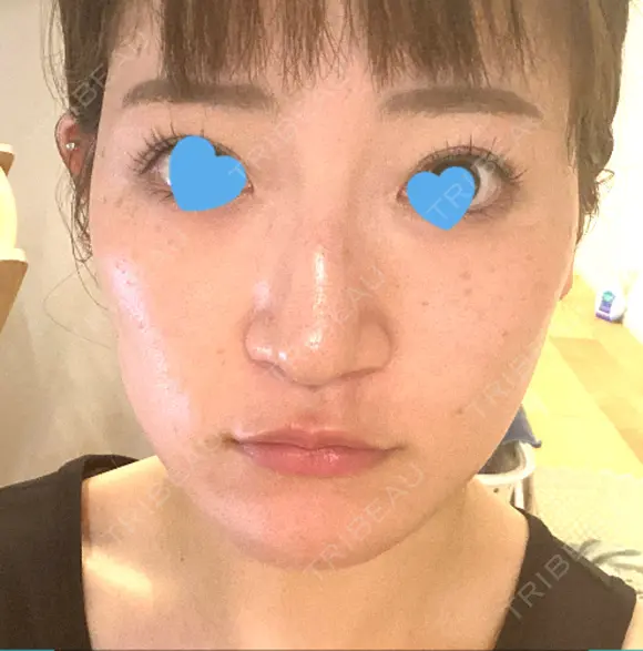 ポテンツァ レナータクリニック 立川院 DAY 2 メイン用