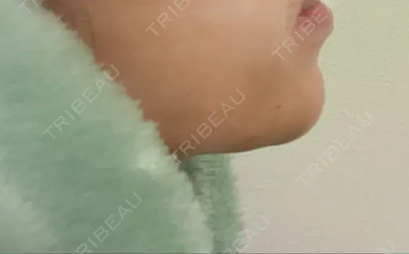 ヒアルロン酸注入（あご） TCB東京中央美容外科 堺院 DAY 4 メイン用