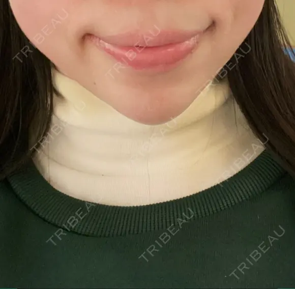 ヒアルロン酸注入（あご） TCB東京中央美容外科 堺院 DAY 4 メイン用