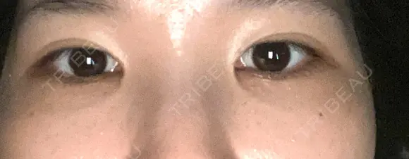 目頭切開 eクリニック 金沢本院 AFTER メイン用