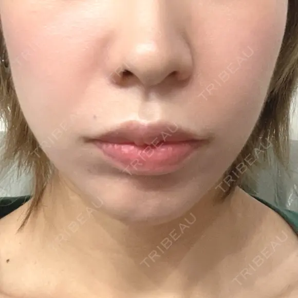 肌ヒアルロン酸注入（たるみ・シワ改善） STARS CLINIC DAY 2 メイン用