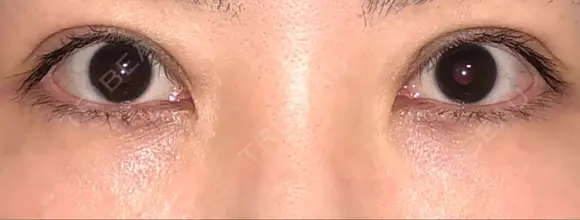 二重切開 / 眼瞼下垂（切開） / 目元修正 トップフェイス整形外科 DAY 127 メイン用