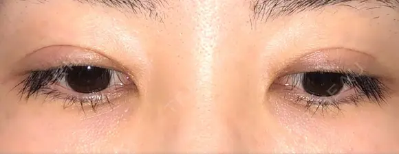 二重切開 / 眼瞼下垂（切開） / 目元修正 トップフェイス整形外科 DAY 127 メイン用