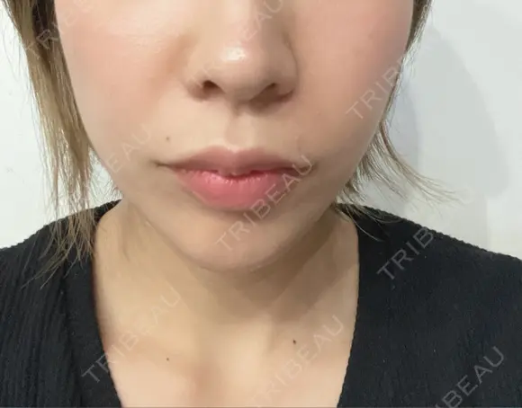 肌ヒアルロン酸注入（たるみ・シワ改善） STARS CLINIC DAY 3 メイン用