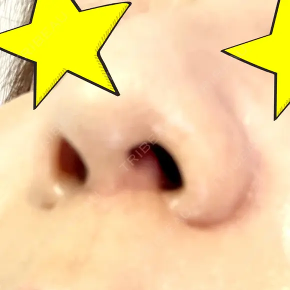 人中短縮 / 鼻翼基部形成（貴族手術） / その他（口元） eクリニック 金沢本院 DAY 303 メイン用